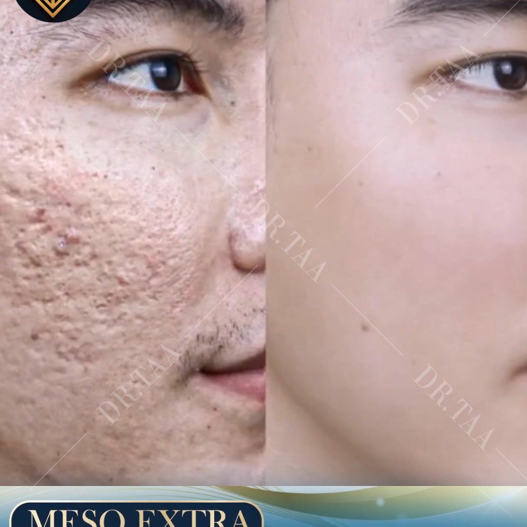 Dr.Taa Clinic - K Beauty center Poipet Facebook ad: SAY GOODBYE TO ACNE SCARS