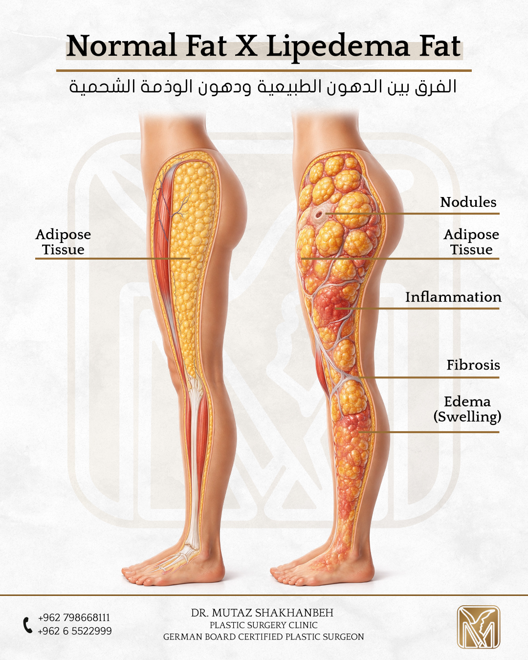 الدكتور معتز الشخانبه Dr. Mutaz Shakhanbeh Facebook ad: لماذا من المهم التمييز بين الدهون الطبيعية ودهون…