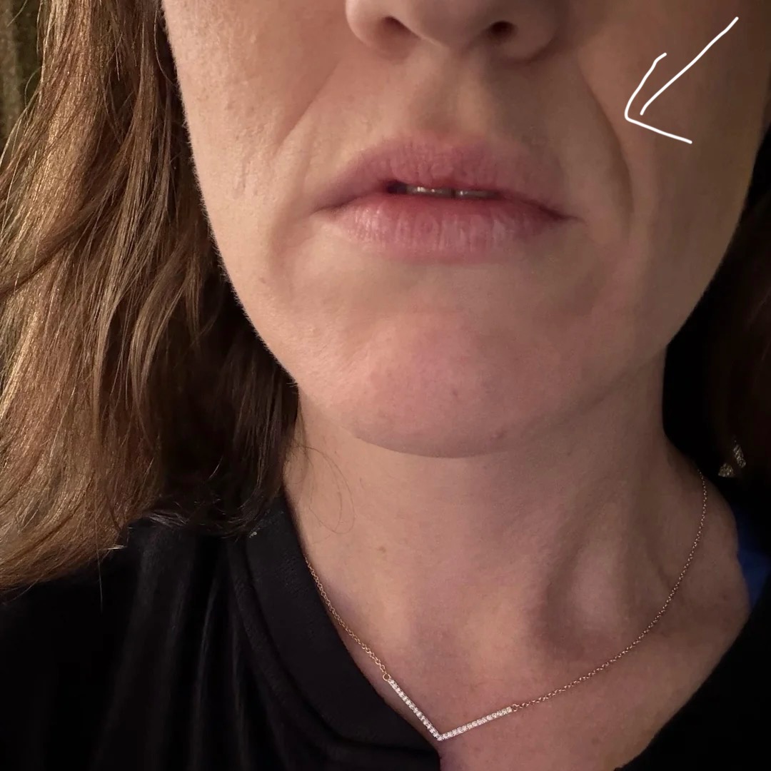 Emma's Skincare Blog Facebook ad: My answer for obsessively thinking about my smile lines…