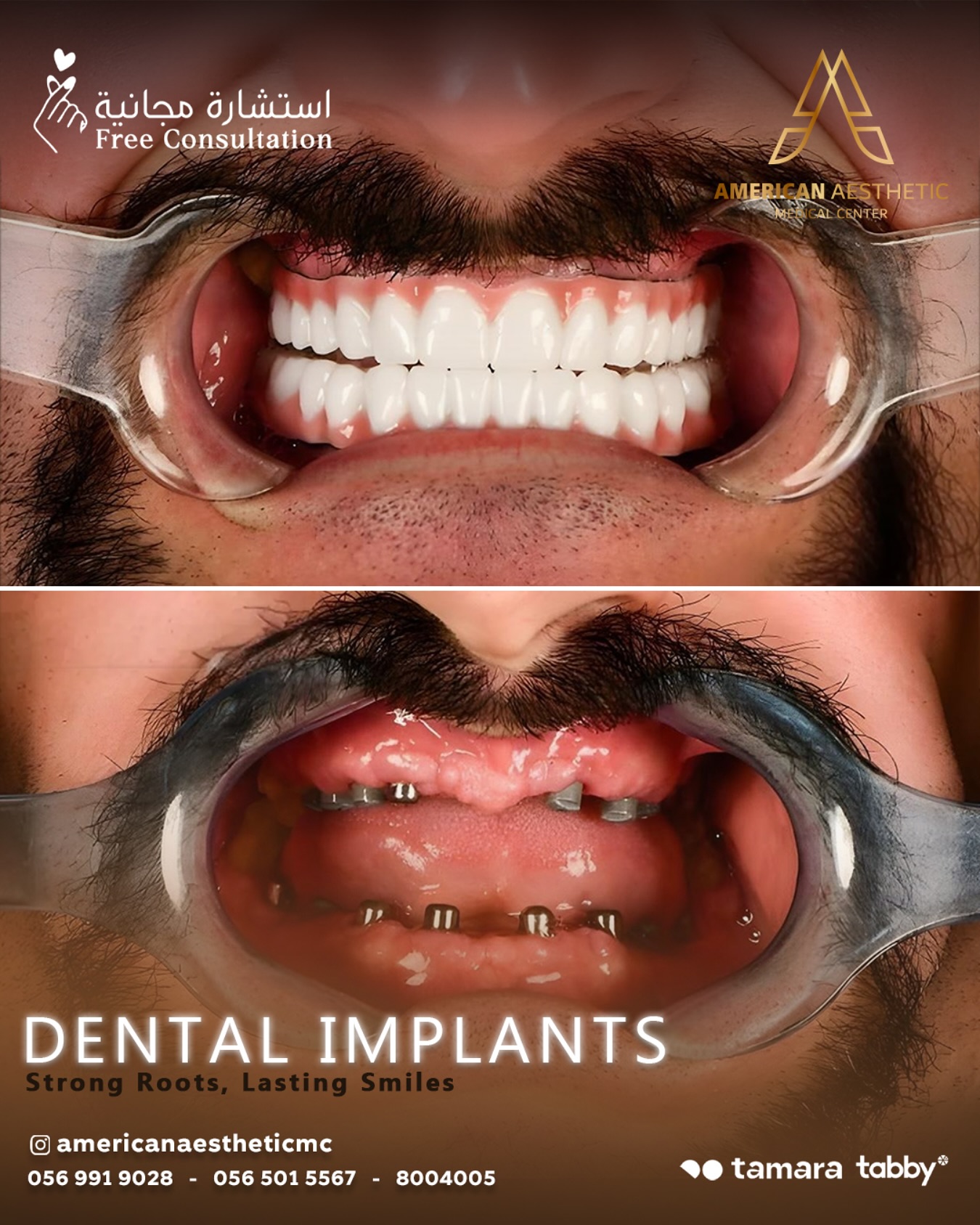 American Aesthetic Medical Center Facebook ad: زراعة الأسنان لابتسامة تدوم