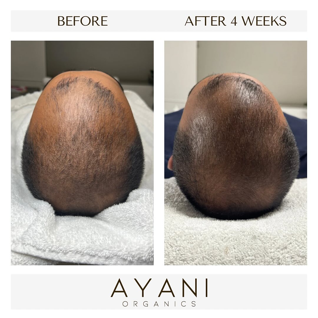 AYANI ORGANICS - Herbal Hair Growth Oil Facebook ad: Resultaat al na 4 weken!