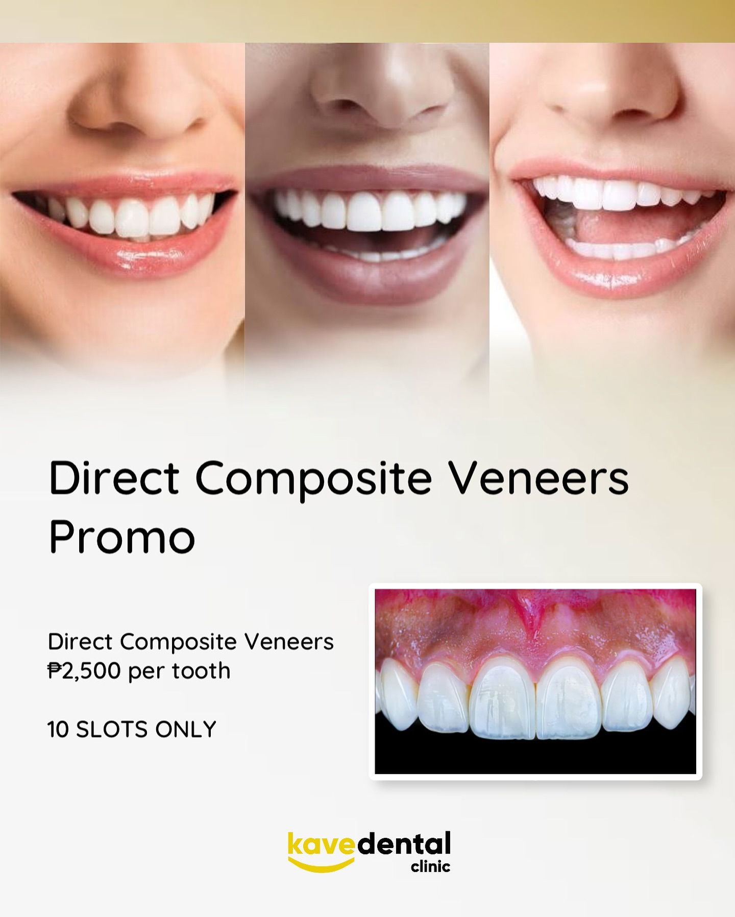 Kave Dental Clinic Facebook ad: PROMO ALERT