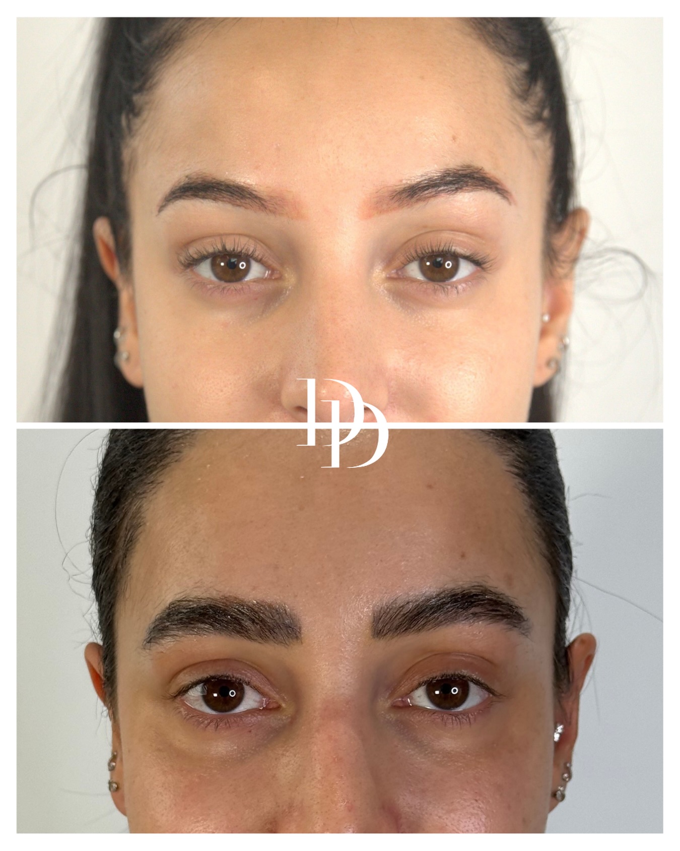 Dr Ducu Clinics Facebook ad: Follow us for real Eyebrow Transplant cases.