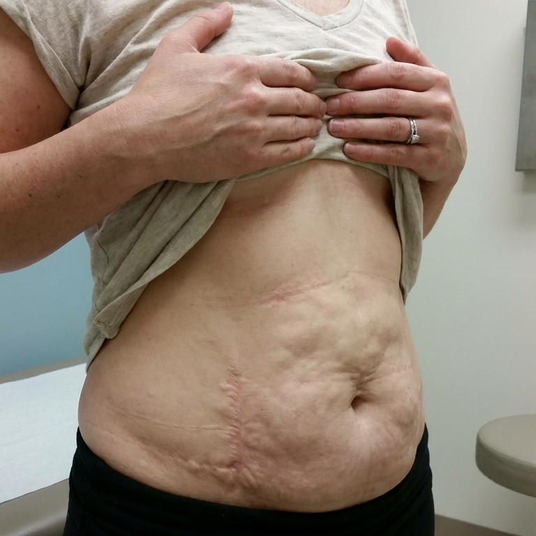 Rebecca M., Registered Dietitian Nutritionist Facebook ad: What I wish I knew before getting Lipo 360
